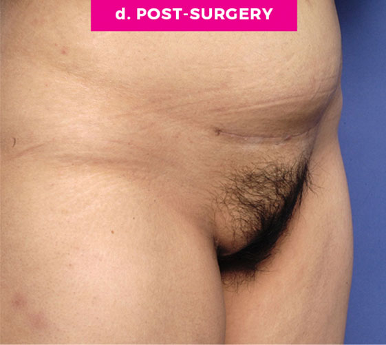 Pubic Mons Patient 1 After Angle