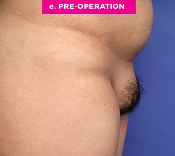 Pubic Mons Patient 1 Before Side