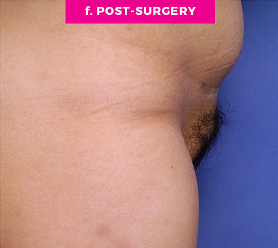 Pubic Mons Patient 1 After Side