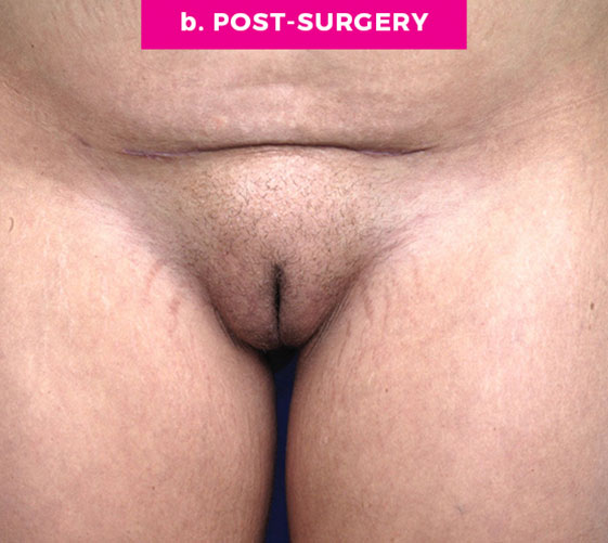 Pubic Mons Patient 2 After