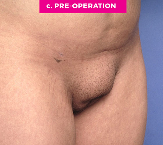 Pubic Mons Patient 2 Before Angle