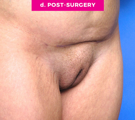 Pubic Mons Patient 2 After Angle