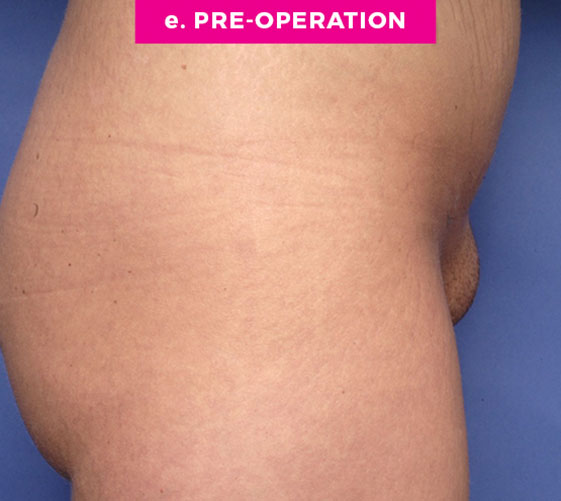 Pubic Mons Patient 2 Before Side