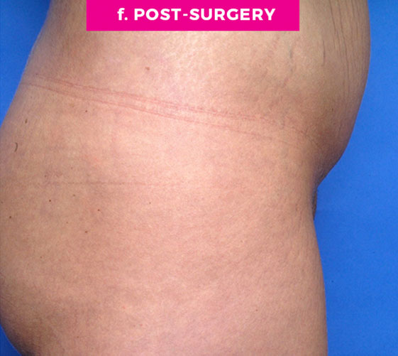 Pubic Mons Patient 2 After Side