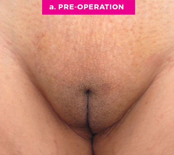 Pubic Mons Patient 3 Before