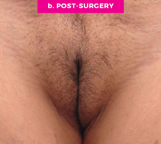 Pubic Mons Patient 3 After