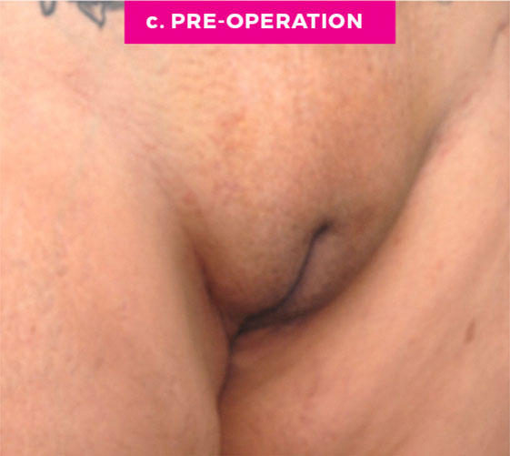 Pubic Mons Patient 3 Before Angle