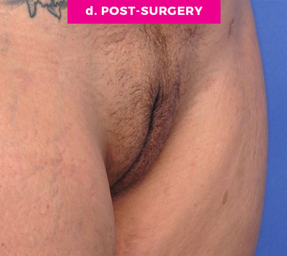 Pubic Mons Patient 3 After Angle