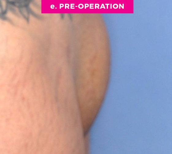 Pubic Mons Patient 3 Before Side