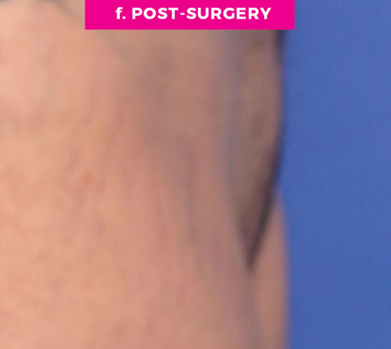 Pubic Mons Patient 3 After Side