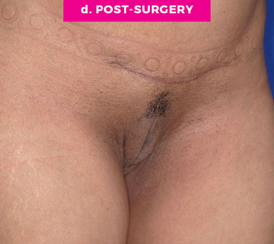 Pubic Mons Patient 4 After Angle