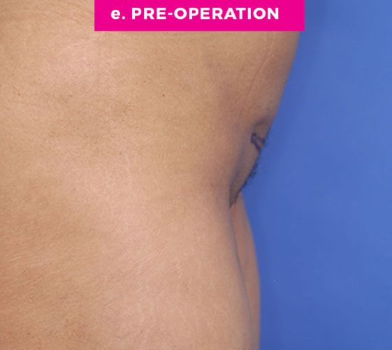 Pubic Mons Patient 4 Before Side