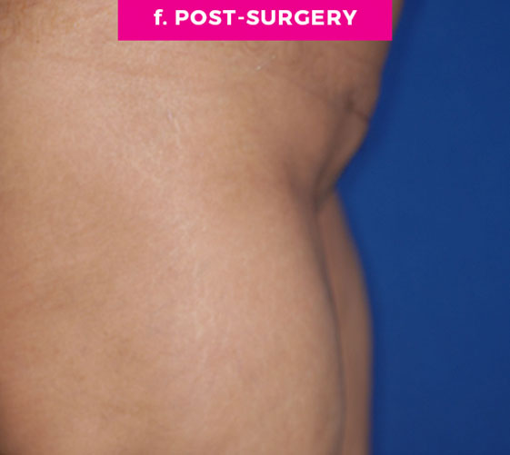 Pubic Mons Patient 4 After Side