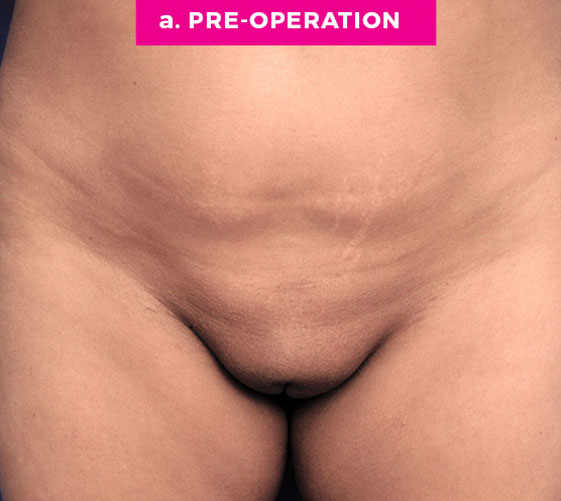 Pubic Mons Patient 5 Before