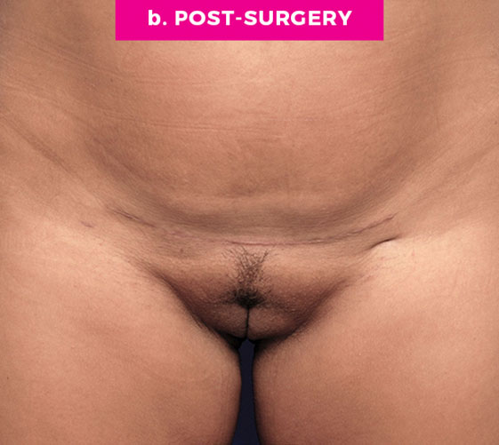 Pubic Mons Patient 5 After