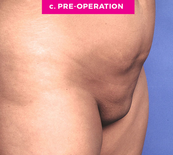 Pubic Mons Patient 5 Before Angle
