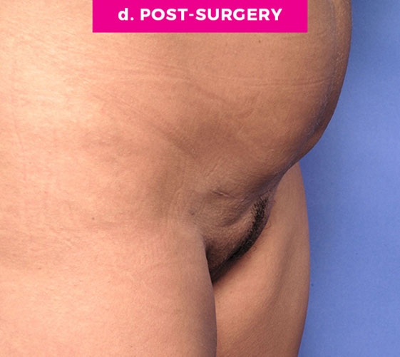 Pubic Mons Patient 5 After Angle