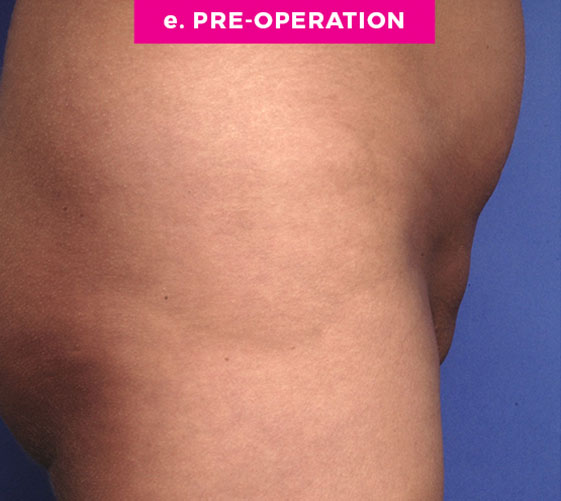 Pubic Mons Patient 5 Before Side