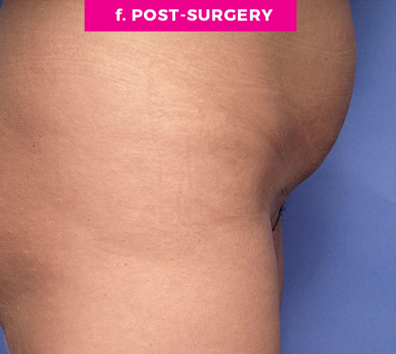 Pubic Mons Patient 5 After Side