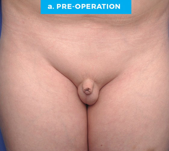 BURIED/HIDDEN PENIS CORRECTIVE SURGERY Patient 1 Before