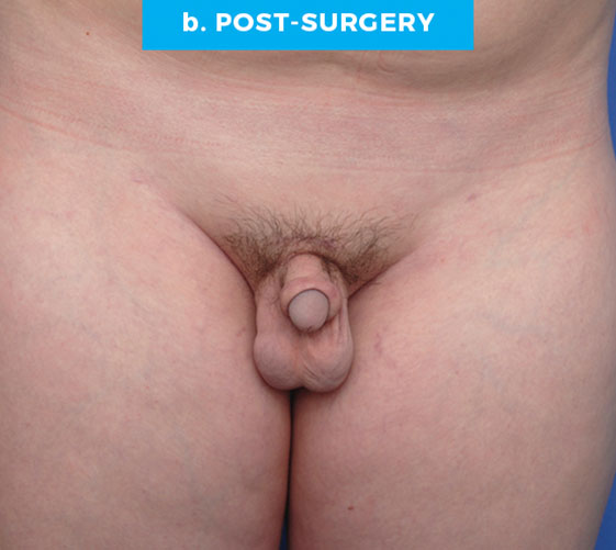 BURIED/HIDDEN PENIS CORRECTIVE SURGERY Patient 1 After