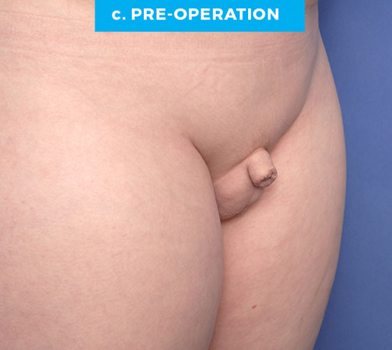 BURIED/HIDDEN PENIS CORRECTIVE SURGERY Patient 1 Before 2