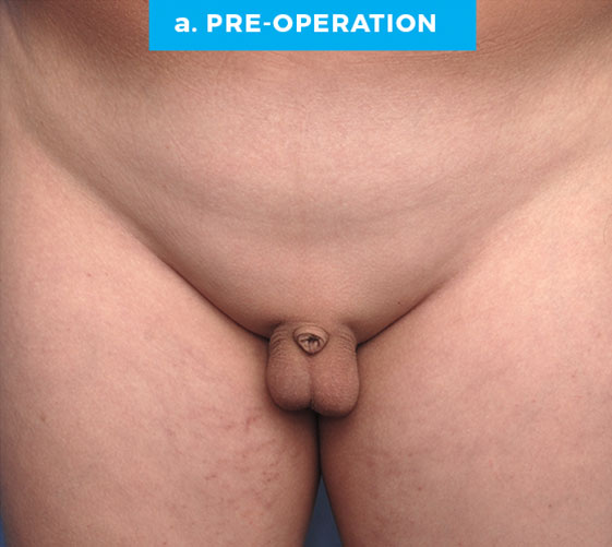 BURIED/HIDDEN PENIS CORRECTIVE SURGERY Patient 3 Before