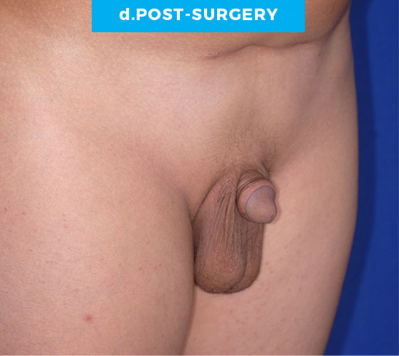 BURIED/HIDDEN PENIS CORRECTIVE SURGERY Patient 3 After 2