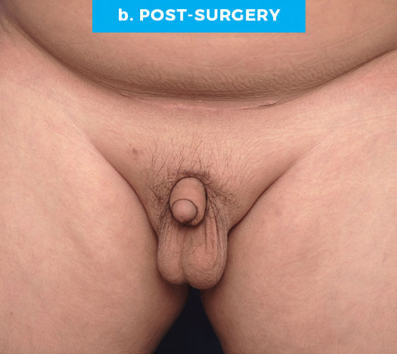 BURIED/HIDDEN PENIS CORRECTIVE SURGERY Patient 4 After
