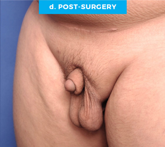 BURIED/HIDDEN PENIS CORRECTIVE SURGERY Patient 4 After 2