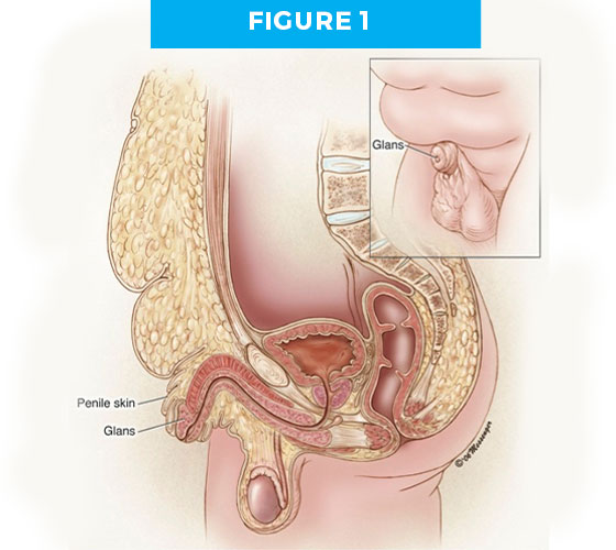 hiddenp-fig1 BURIED/HIDDEN PENIS CORRECTIVE SURGERY Figure 1