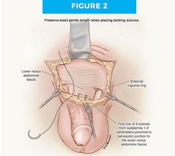 hiddenp-fig2 BURIED/HIDDEN PENIS CORRECTIVE SURGERY Figure 2
