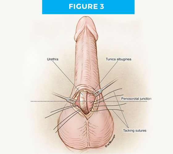 hiddenp-fig3 Hidden penis diagram