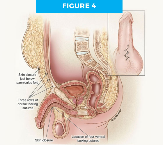 hiddenp-fig4 BURIED/HIDDEN PENIS CORRECTIVE SURGERY Figure 4