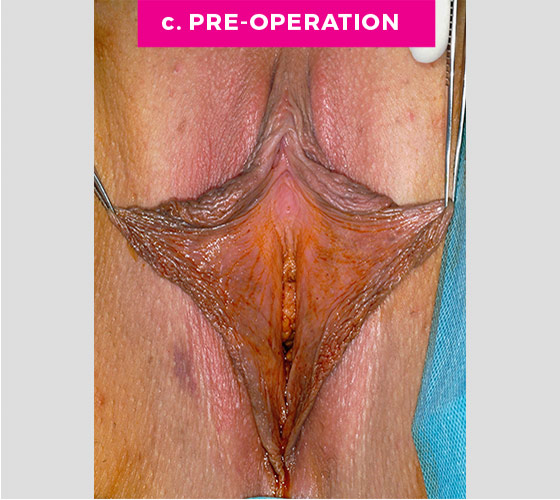 LABIAPLASTY Patient 12 Before 2