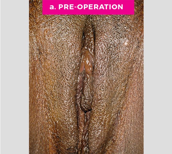 LABIAPLASTY Patient 16 Before