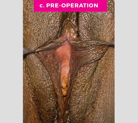LABIAPLASTY Patient 16 Before 2