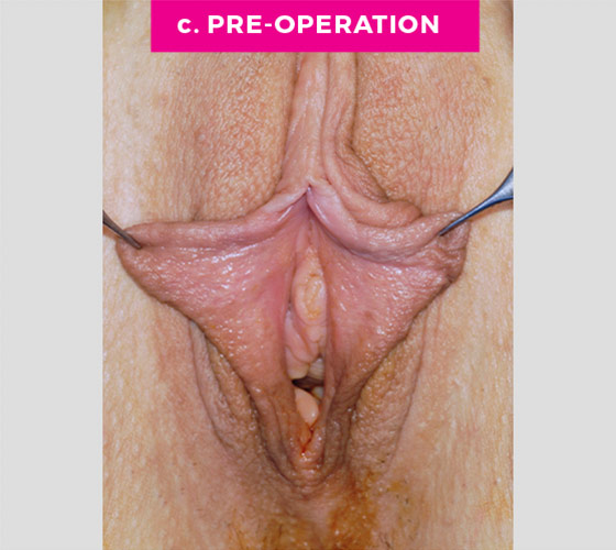 Labiaplasty Patient 6 Before