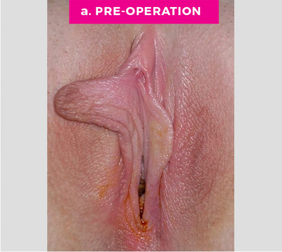 Labiaplasty Patient 10 Before 2