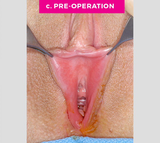 Labiaplasty Patient 11 Before 2
