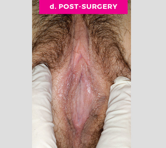 LABIAPLASTY Patient 9 After 2