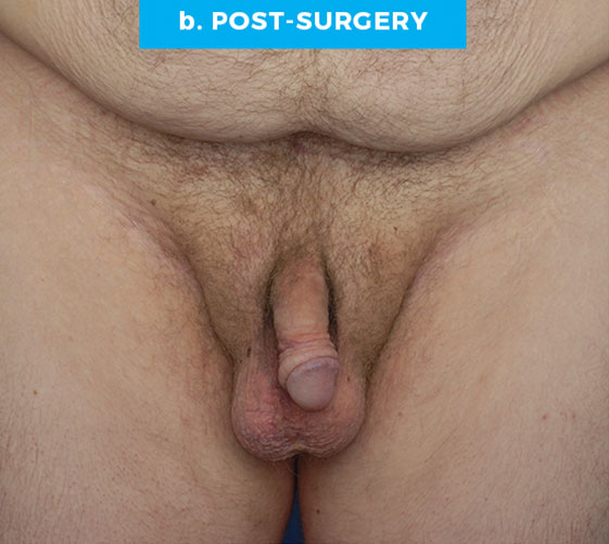 BURIED/HIDDEN PENIS CORRECTIVE SURGERY Patient 1 After
