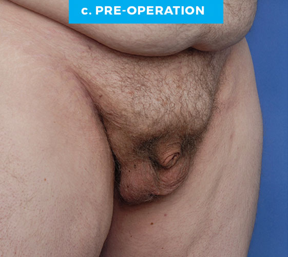 BURIED/HIDDEN PENIS CORRECTIVE SURGERY Patient 1 Before 2