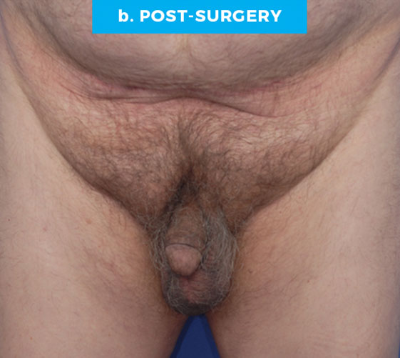 BURIED/HIDDEN PENIS CORRECTIVE SURGERY Patient 2 After