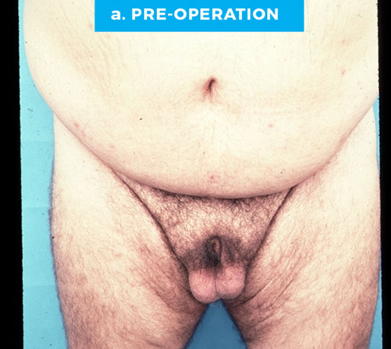 BURIED/HIDDEN PENIS CORRECTIVE SURGERY Patient 4 Before