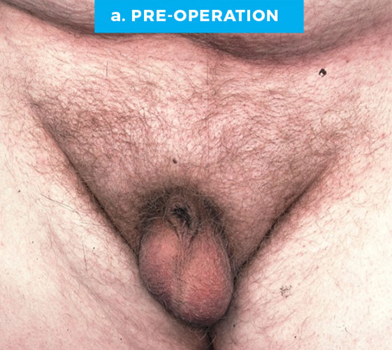 BURIED/HIDDEN PENIS CORRECTIVE SURGERY Patient 3 Before