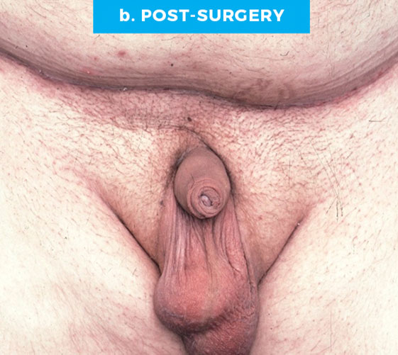 BURIED/HIDDEN PENIS CORRECTIVE SURGERY Patient 3 After