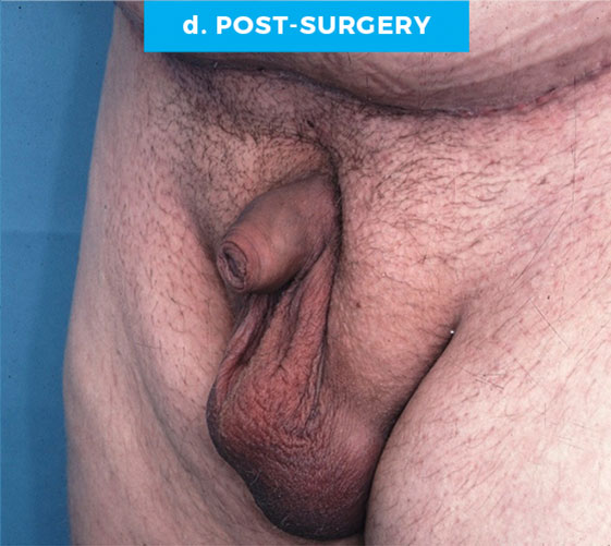 BURIED/HIDDEN PENIS CORRECTIVE SURGERY Patient 3 After 2