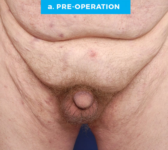 BURIED/HIDDEN PENIS CORRECTIVE SURGERY Patient 10 Before