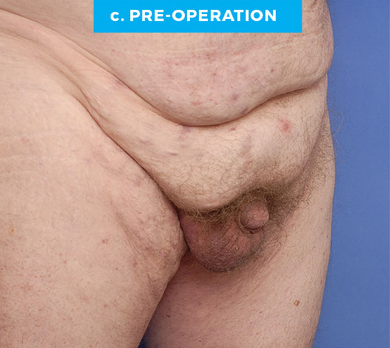 BURIED/HIDDEN PENIS CORRECTIVE SURGERY Patient 10 Before 2